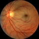 Central Retinal Artery Occlusion HM Central Retinal Artery Occlusion HM